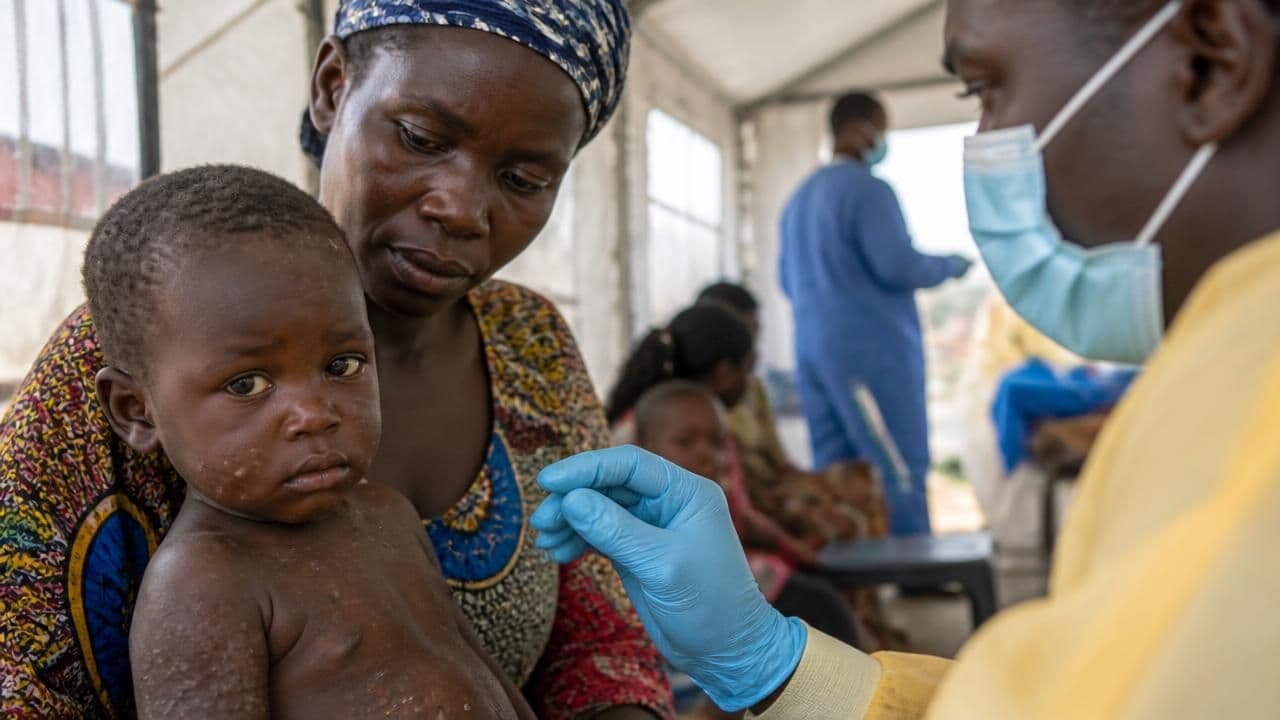 Mpox Resurges Worldwide: New Strains, New Countries, and a Deepening Crisis